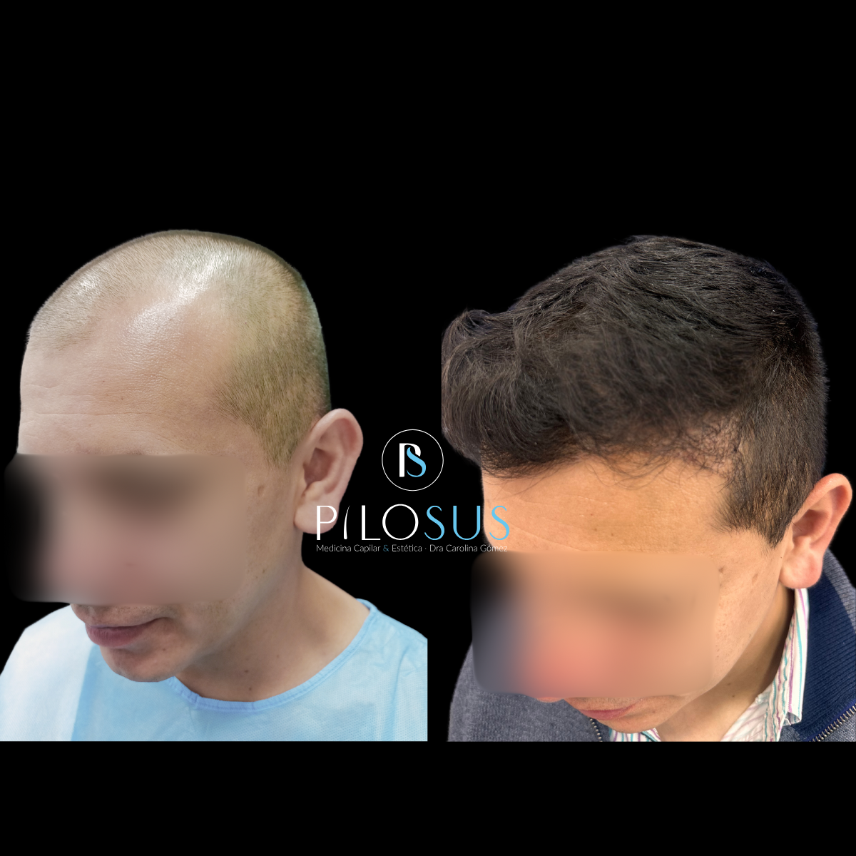 Caso real de restauración capilar, Pilosus