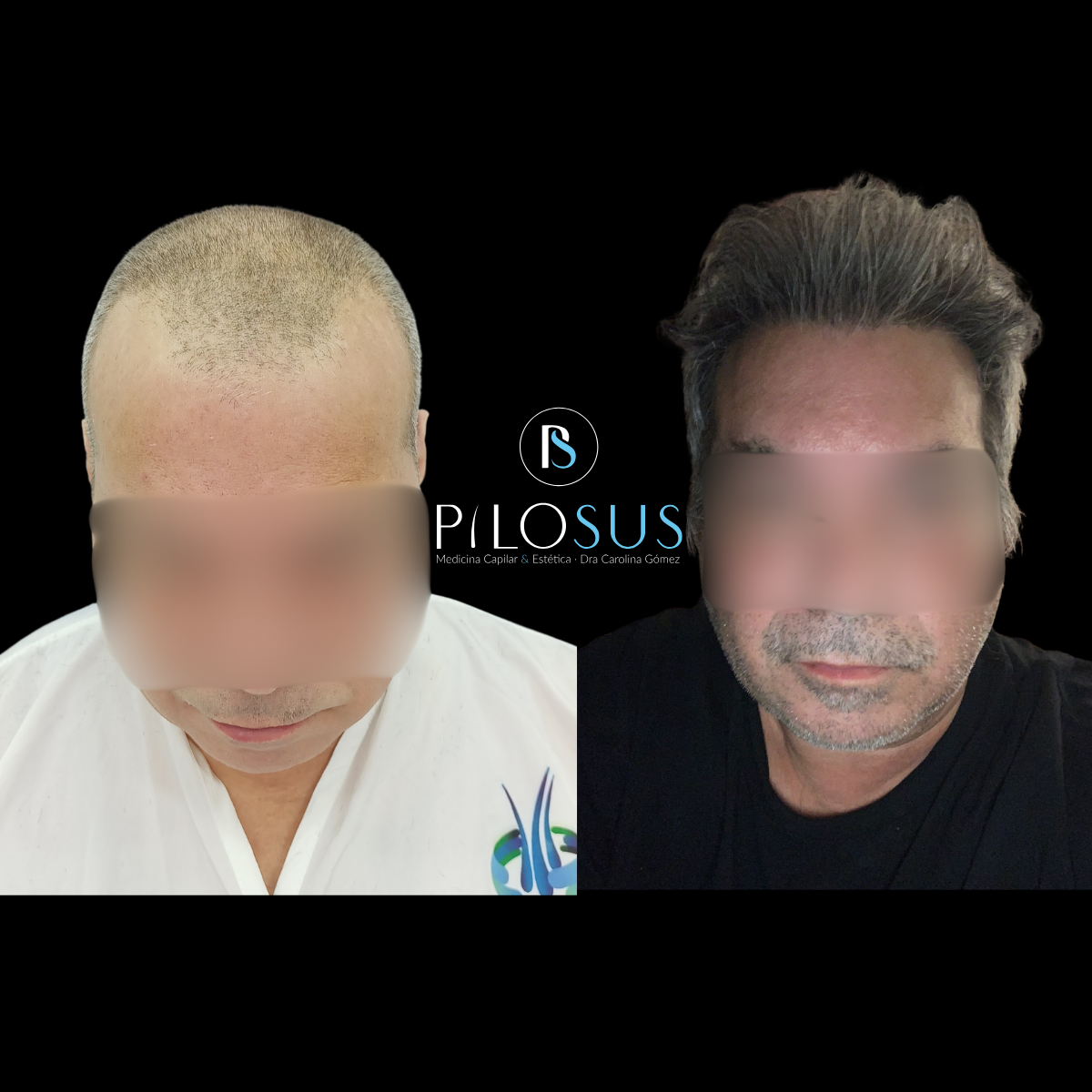 Caso real de restauración capilar, Pilosus