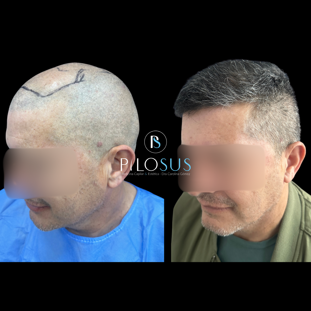Caso real de restauración capilar, Pilosus