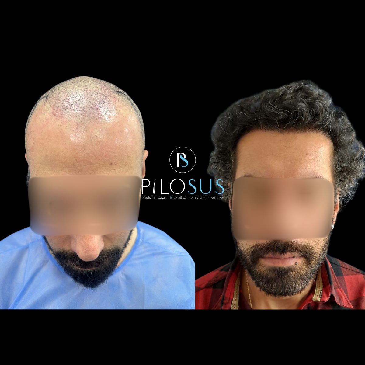 Caso real de restauración capilar, Pilosus