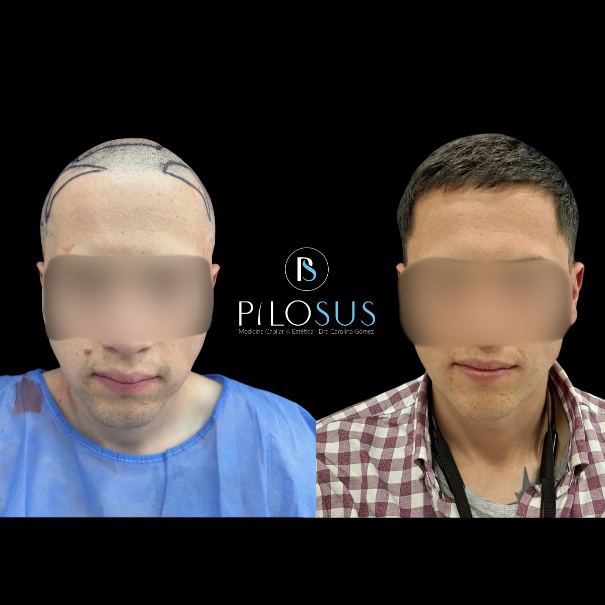 Caso real de restauración capilar, Pilosus