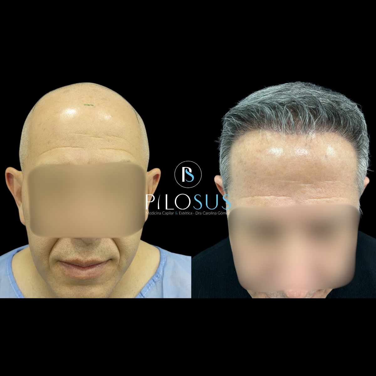 Caso real de restauración capilar, Pilosus