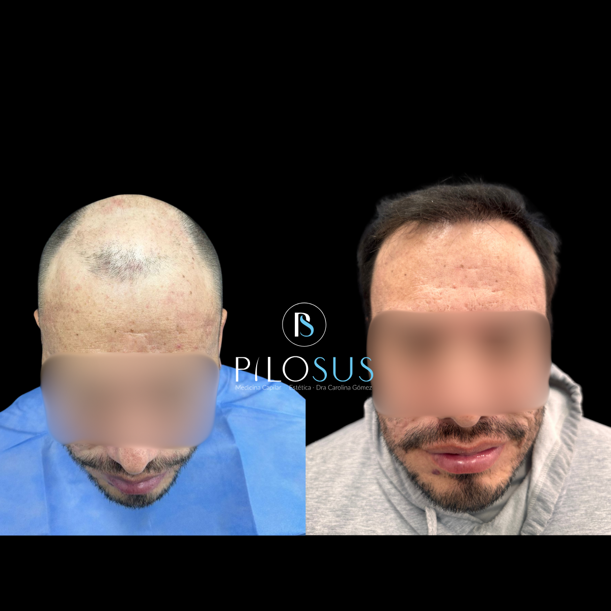 Caso real de restauración capilar, Pilosus