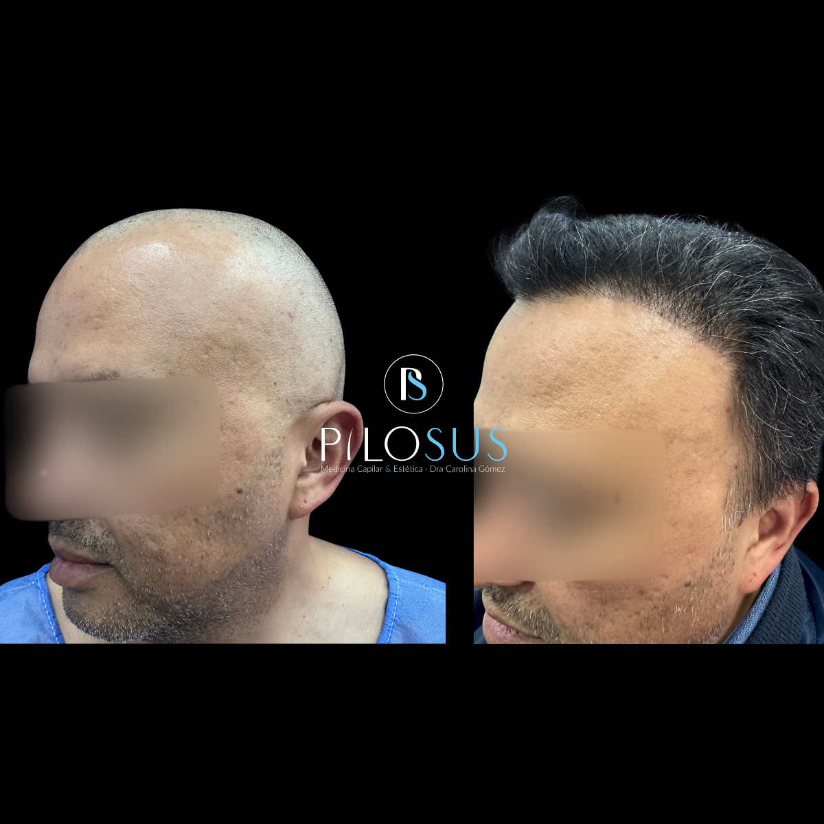 Caso real de restauración capilar, Pilosus