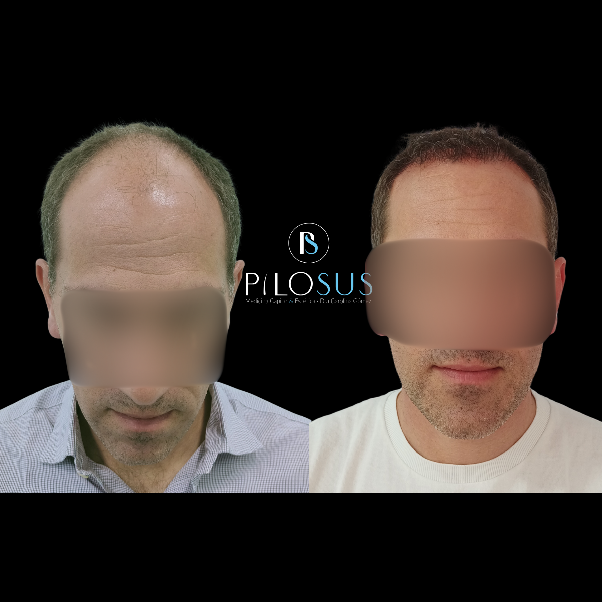 Caso real de restauración capilar, Pilosus