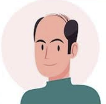 Moderate to advanced hair loss