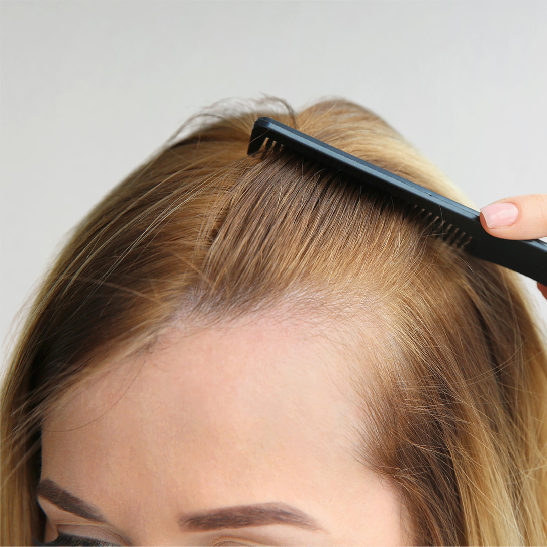 SkinOvation Advanced Aesthetics - Keralase Hair Loss Treatment