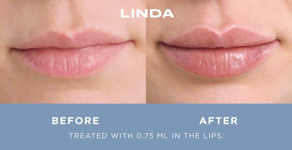 Lip filler detail