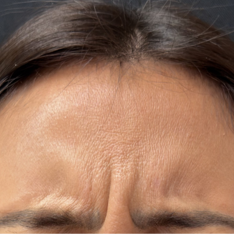 Injectables before