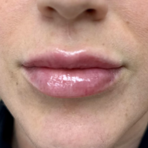 Injectables after
