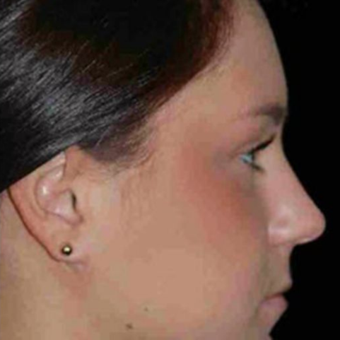 Surgical after