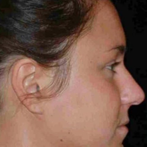Surgical before