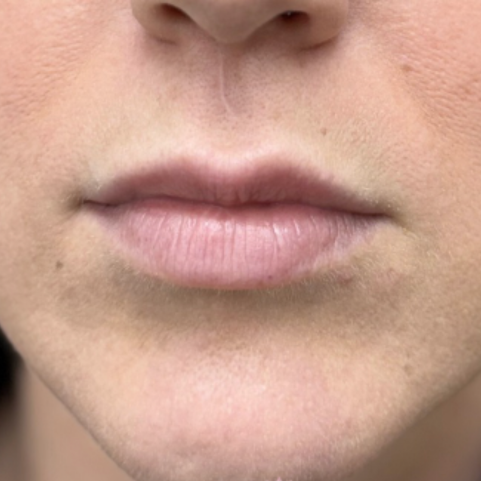 Injectables before