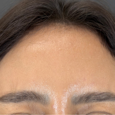 Injectables after