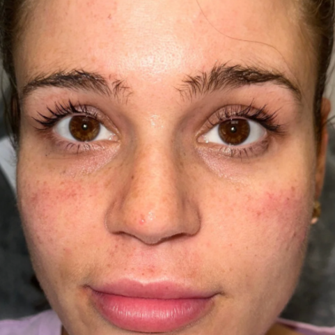 Laser before