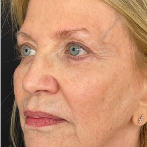 Skin tightening before