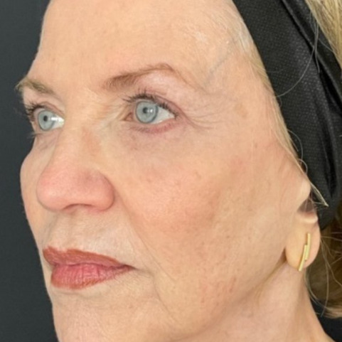 Skin tightening after