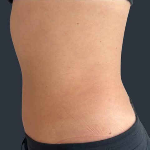 Body contouring after