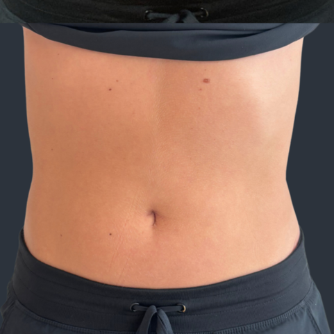 Body contouring after
