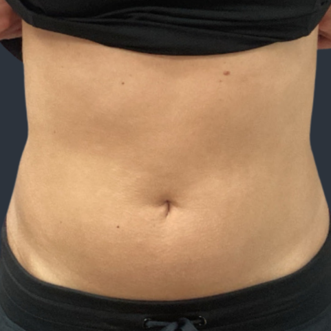 Body contouring before