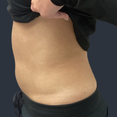 Body contouring before
