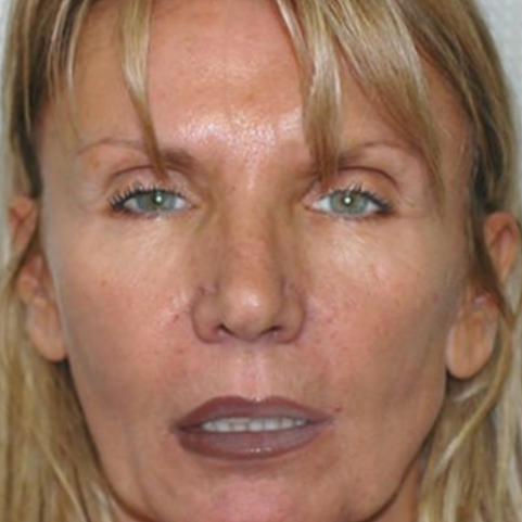 Surgical before