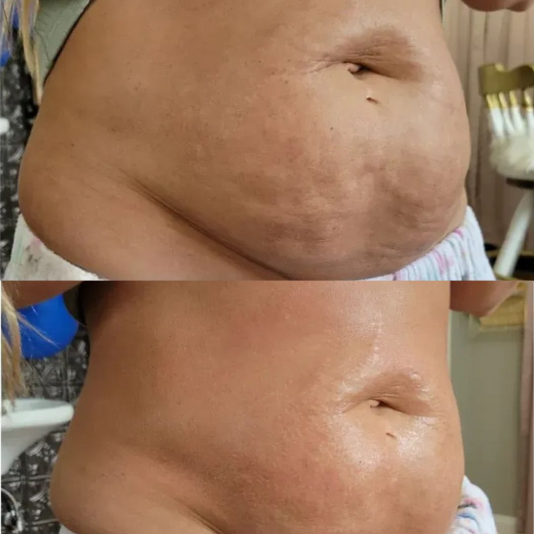 Radio Frequency Treatment Result