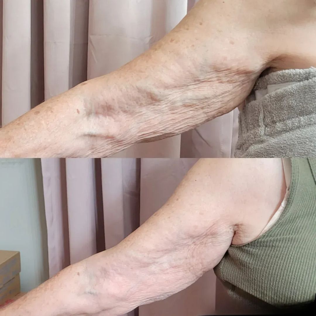 Neurotris Microcurrent Treatment Result