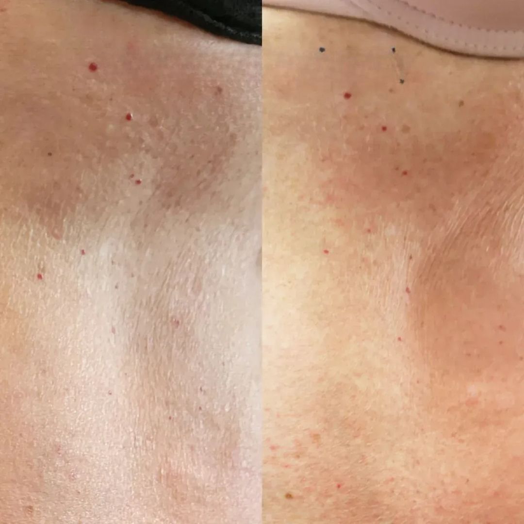 Bio-Reconstruction Treatment