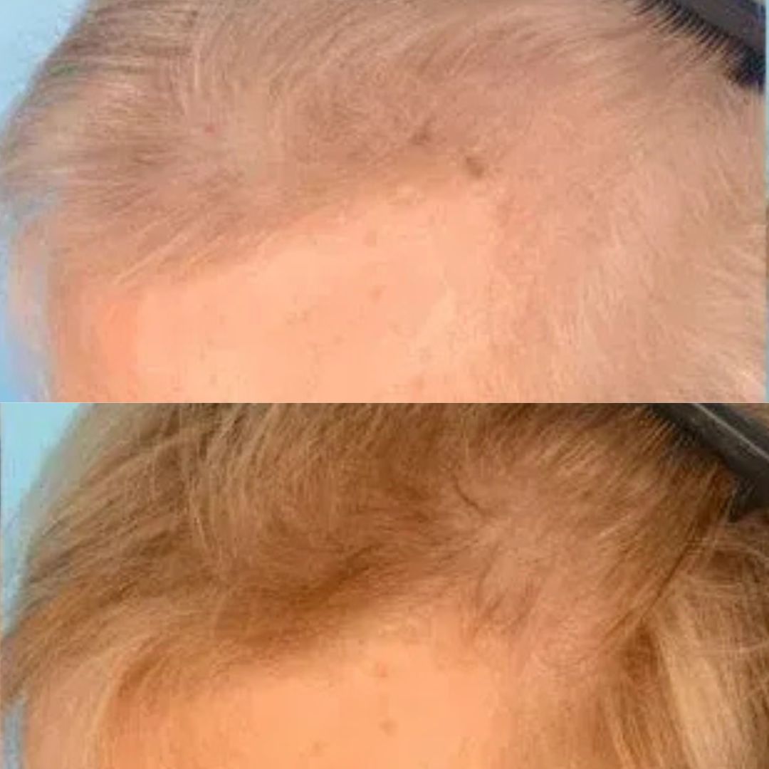 Radio Frequency Treatment Result