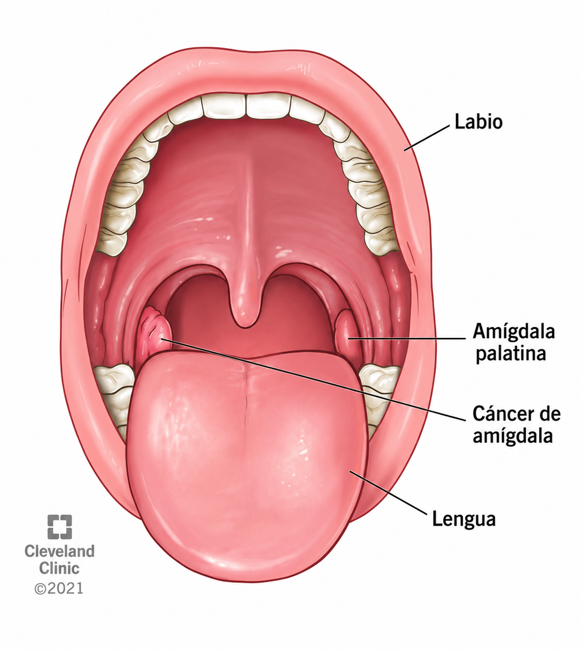 Cáncer de amígdalas en la amígdala con la boca bien abierta.