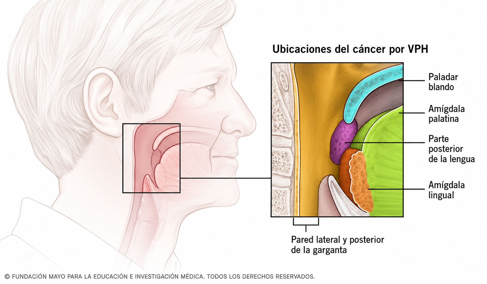 El VPH aumenta el riesgo de cáncer de garganta, paladar blando, amígdalas y parte posterior de la lengua.