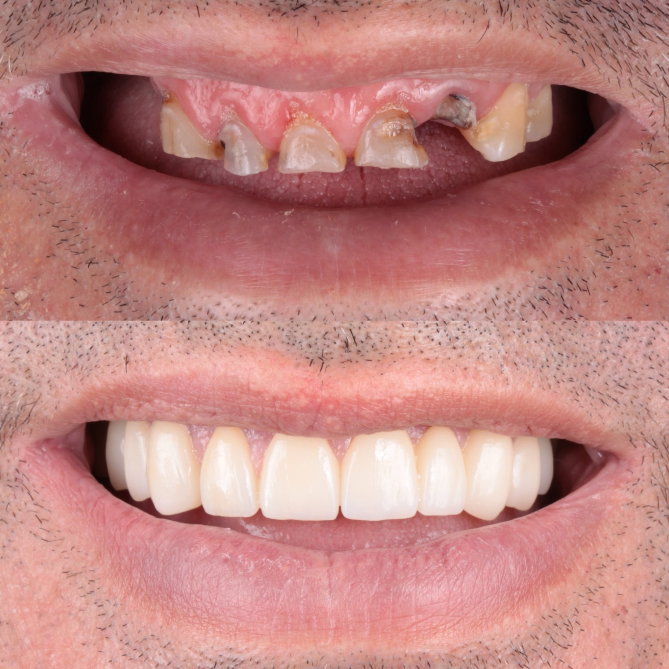 Antes y después implantes dentales Clínica Baldrich