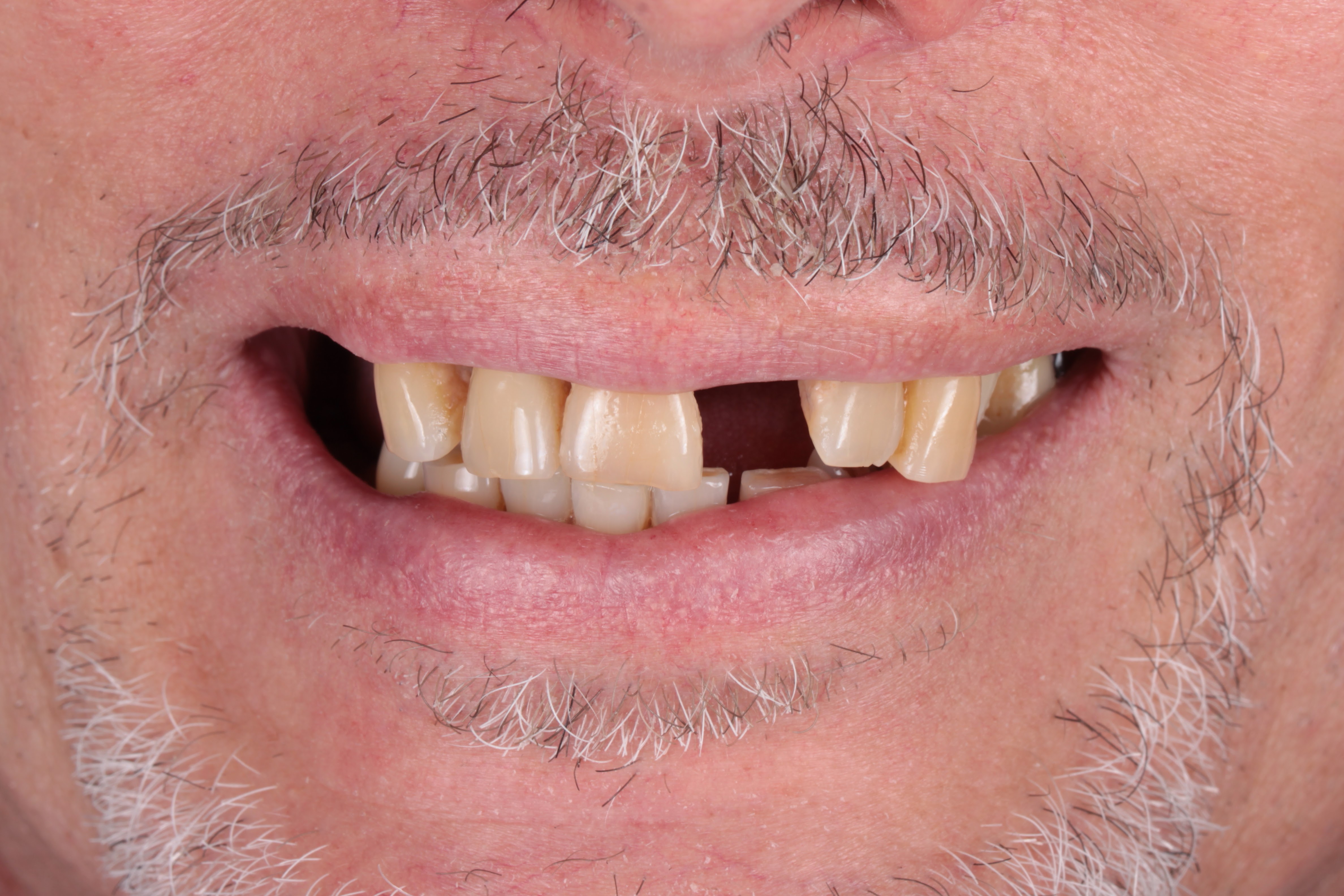 Antes implantes dentales