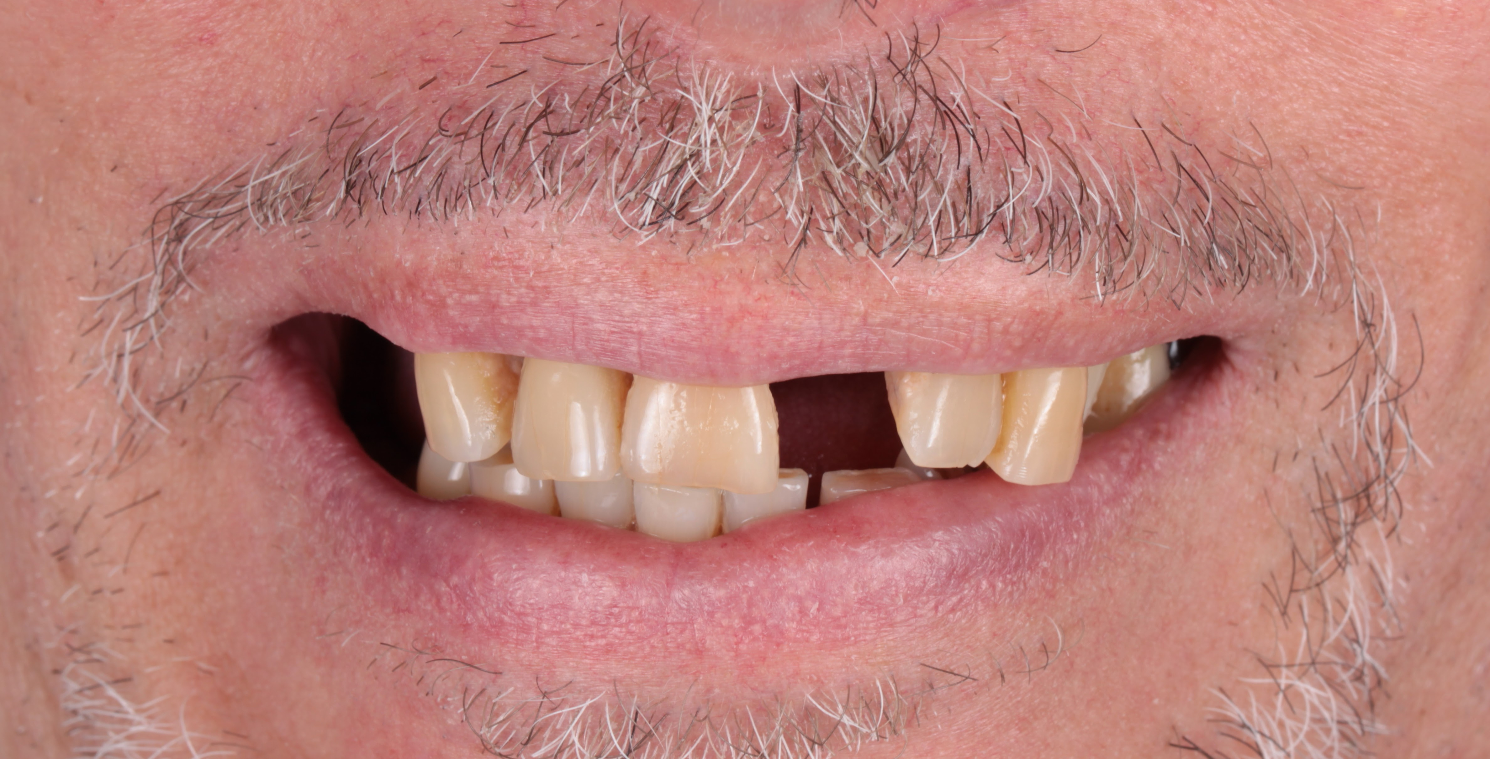 Antes implantes