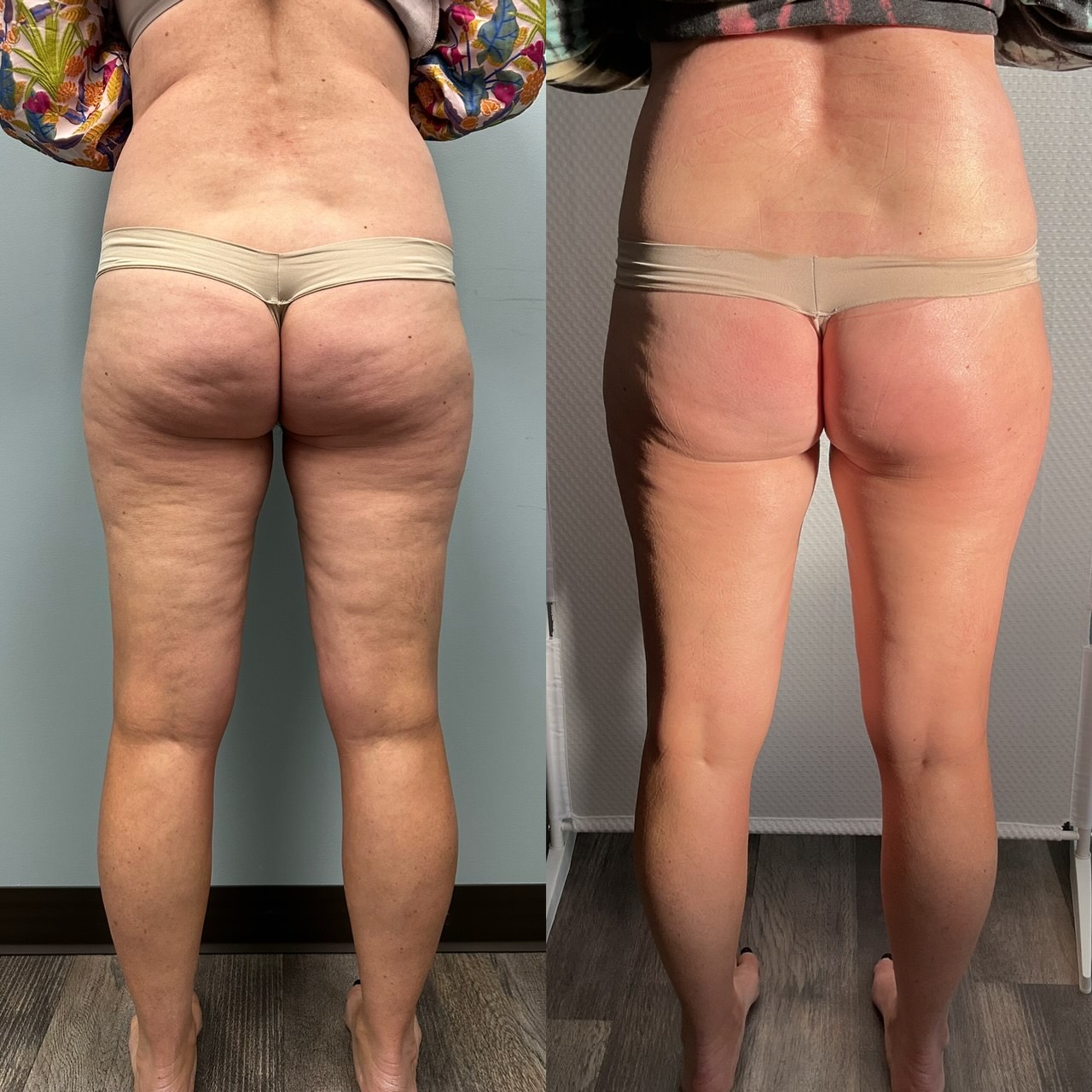 Before and after image showcasing significant skin tightening results on the thighs and buttocks, illustrating improved firmness and reduced sagging, relevant to non-invasive skin rejuvenation treatments at My Ageless Lounge.