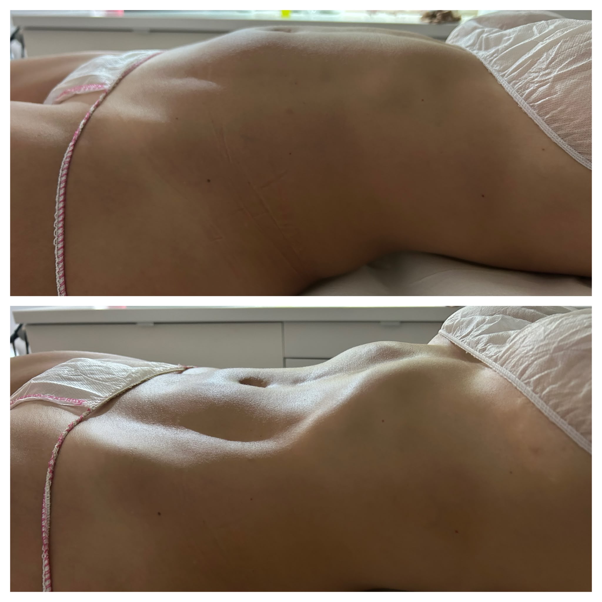 Antes y después Bell Contour - caso real