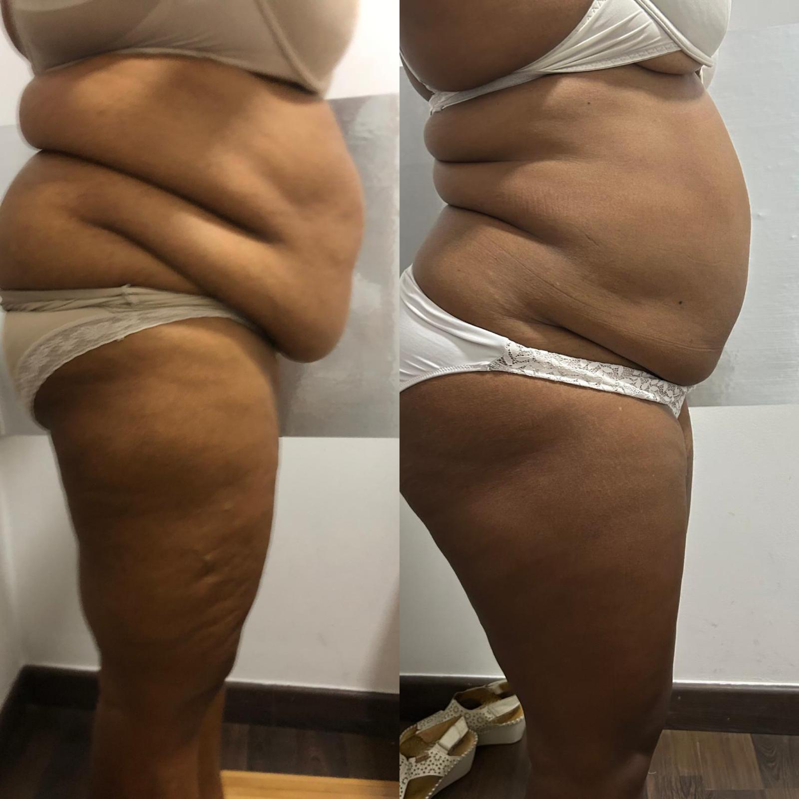 Antes y después Bell Contour - imagen orientativa