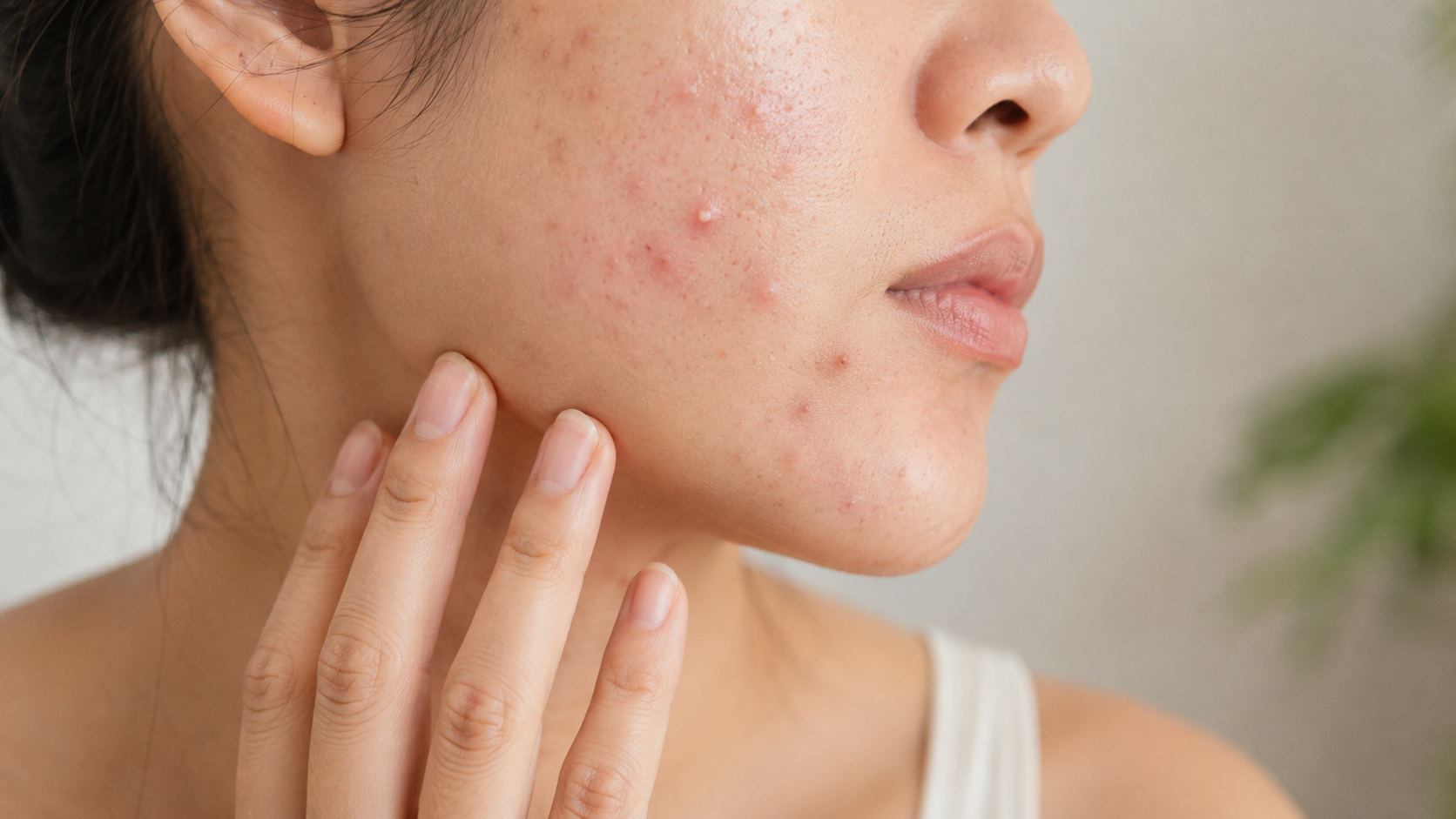 Person with inflammatory acne breakouts on the cheek and jawline