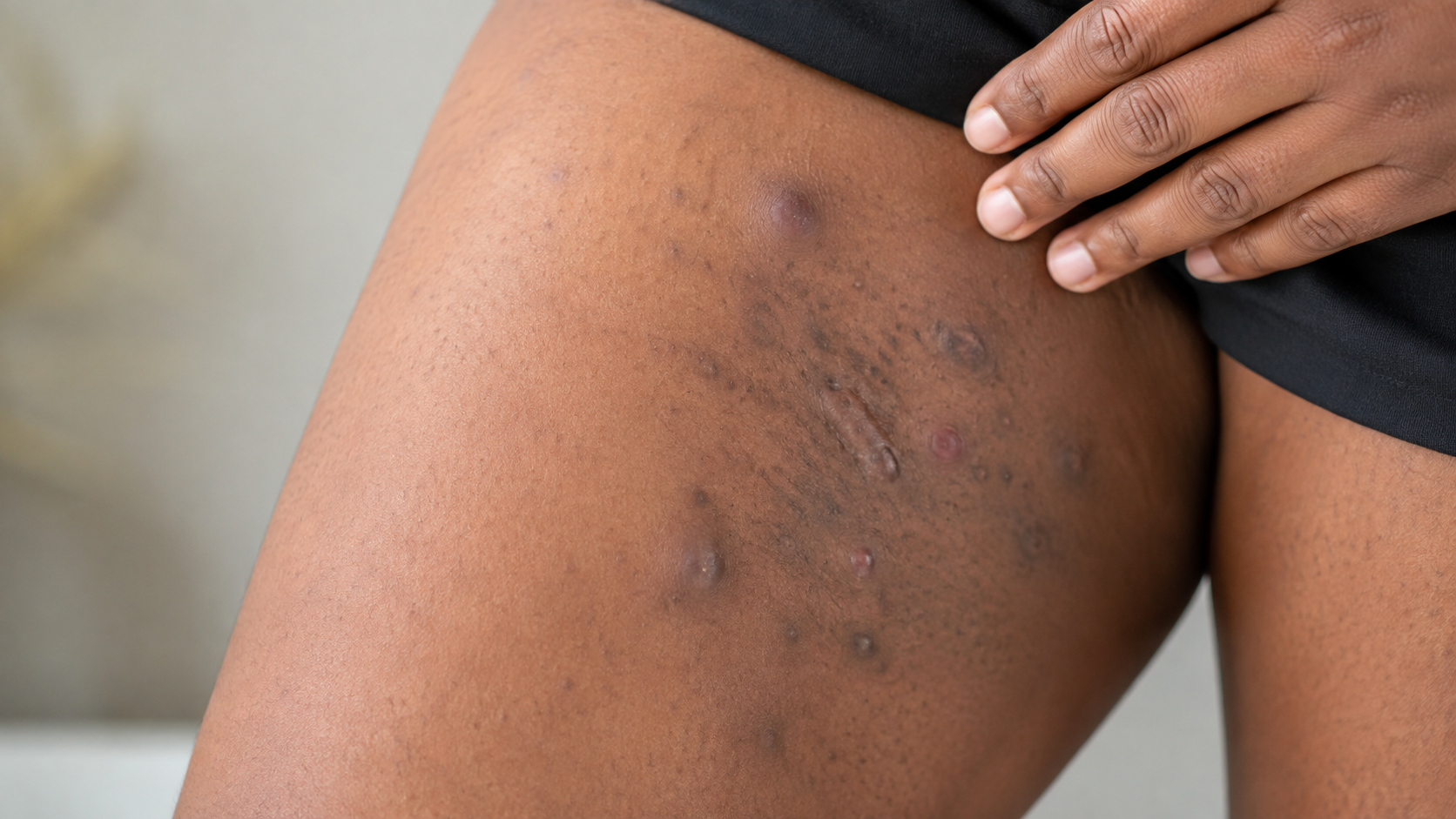 Person with inflamed, boil-like nodules and abscesses in skin folds consistent with hidradenitis suppurativa