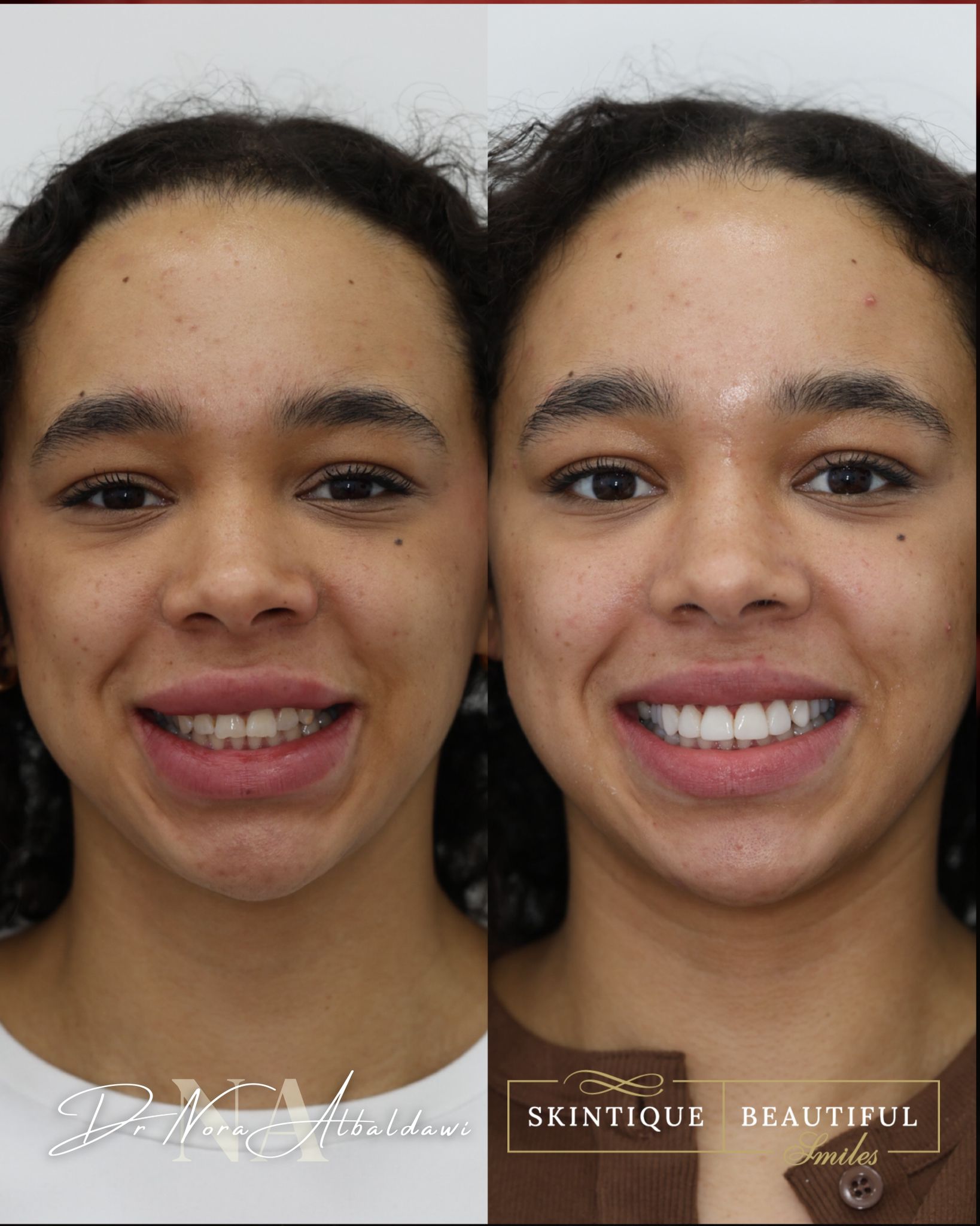 Before and after composite bonding treatment