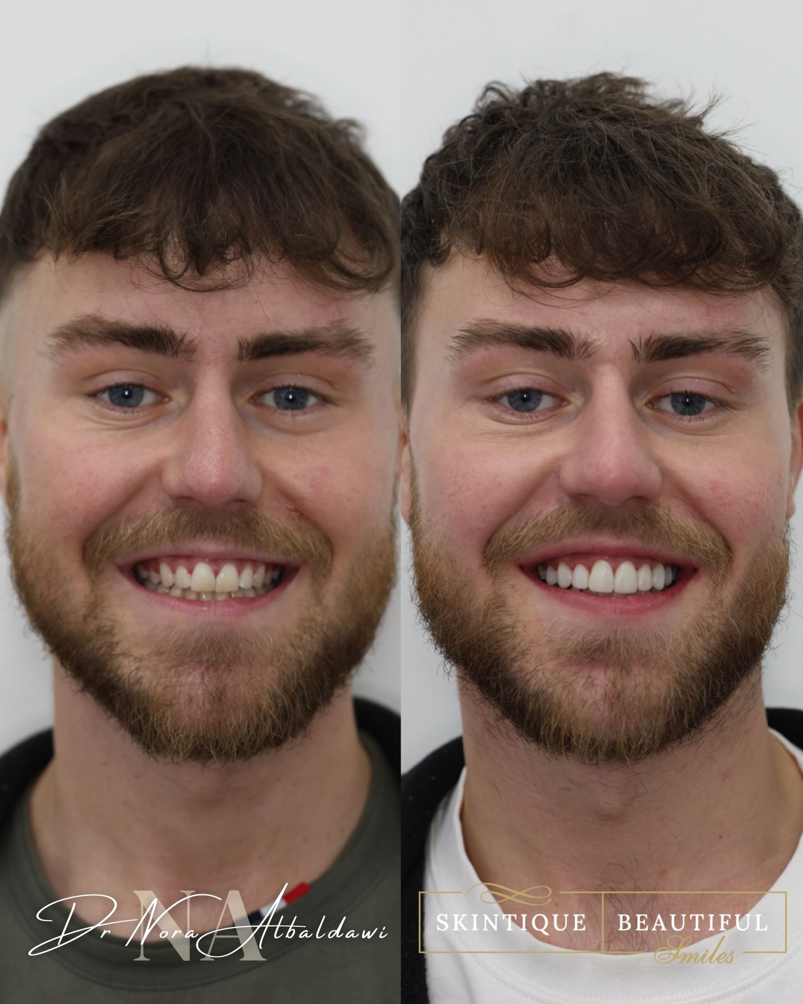 Composite bonding smile makeover result