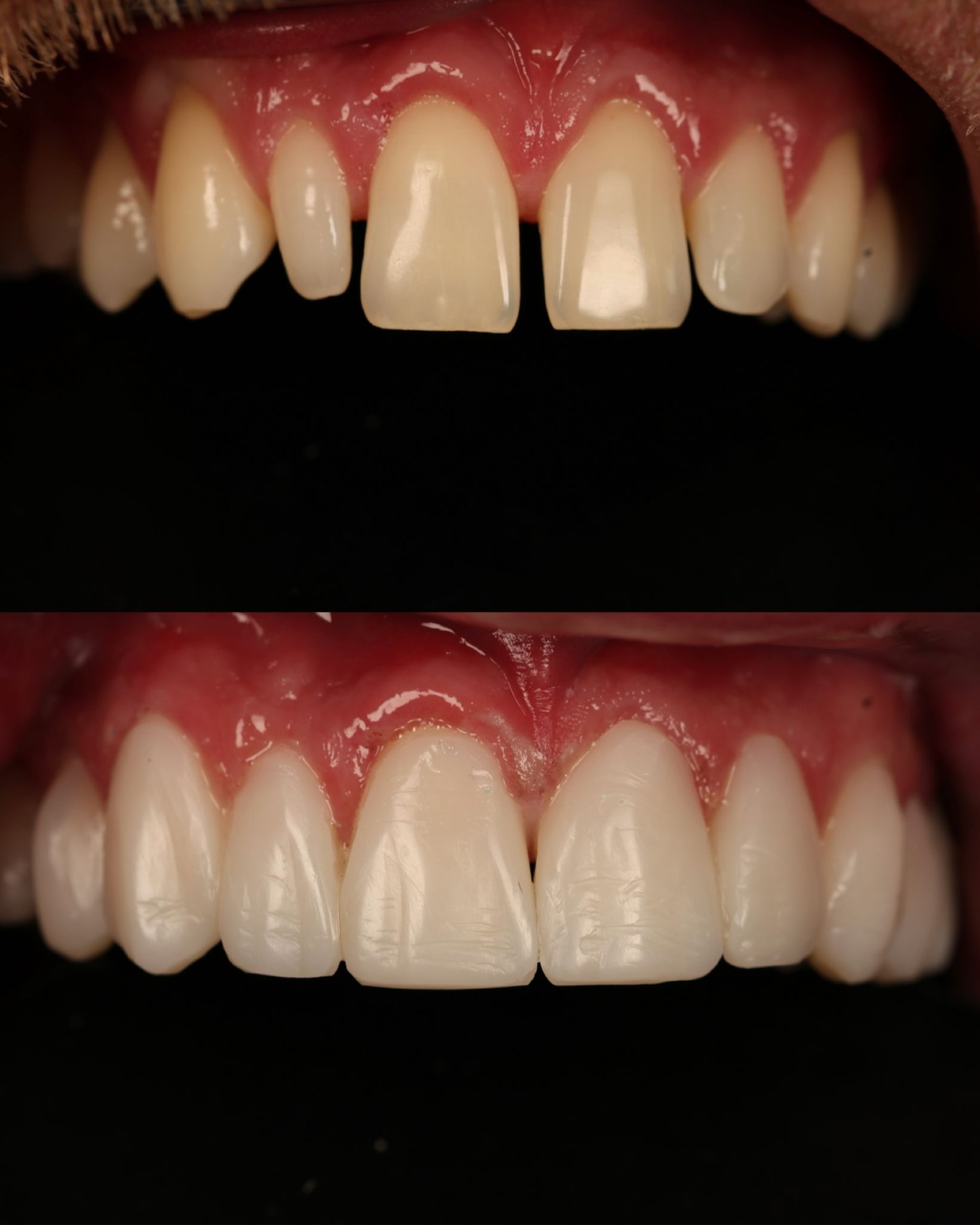 Composite bonding smile transformation result