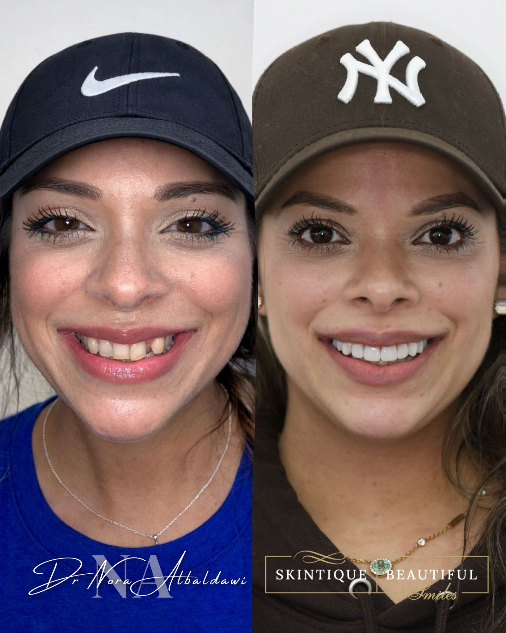 Composite bonding smile result at Skintique Beautiful Smiles Leicester