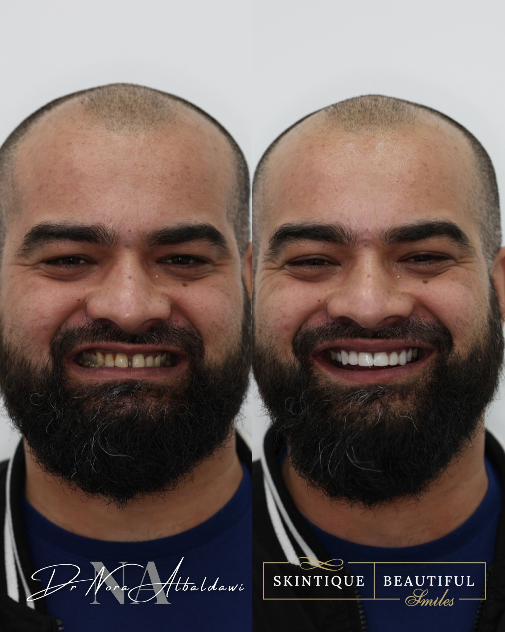 Natural smile restoration before and after result