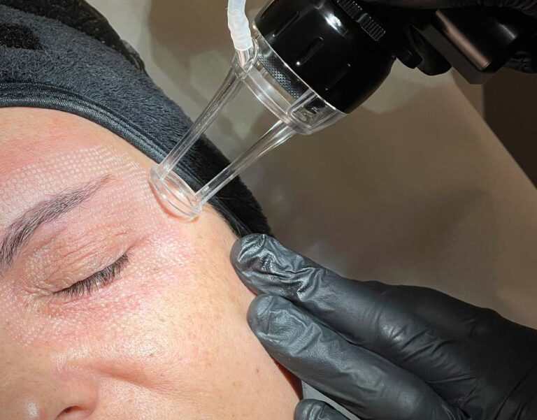 Non Surgical Blepharoplasty