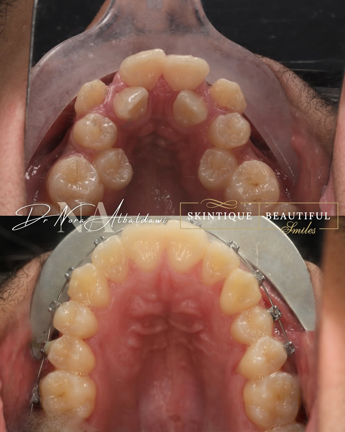 Patient with Damon fixed braces at Skintique Beautiful Smiles