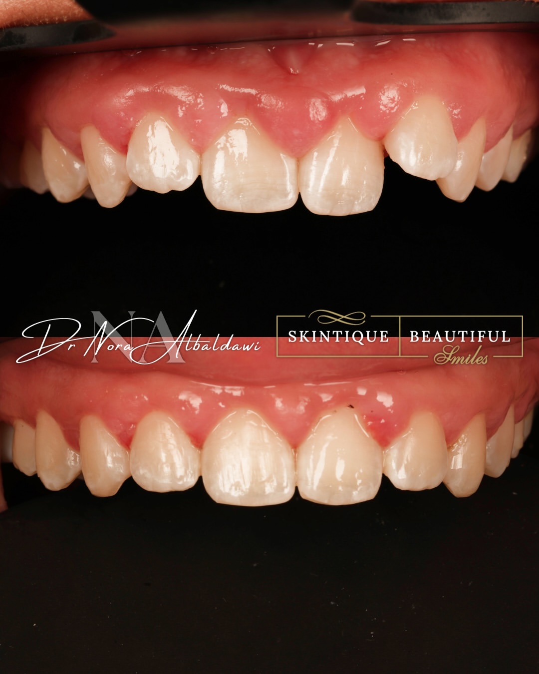 Damon braces treatment journey