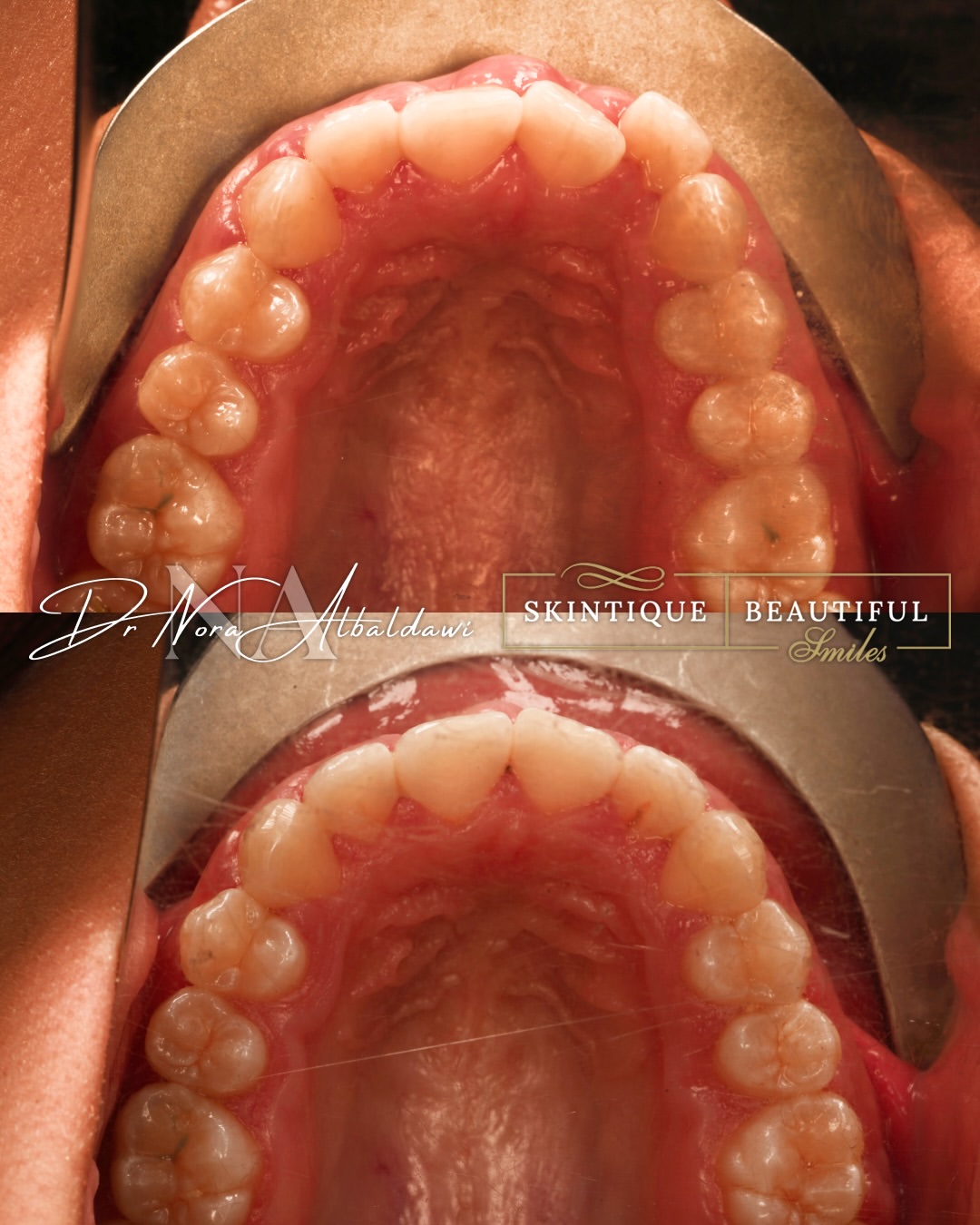Damon braces smile progress