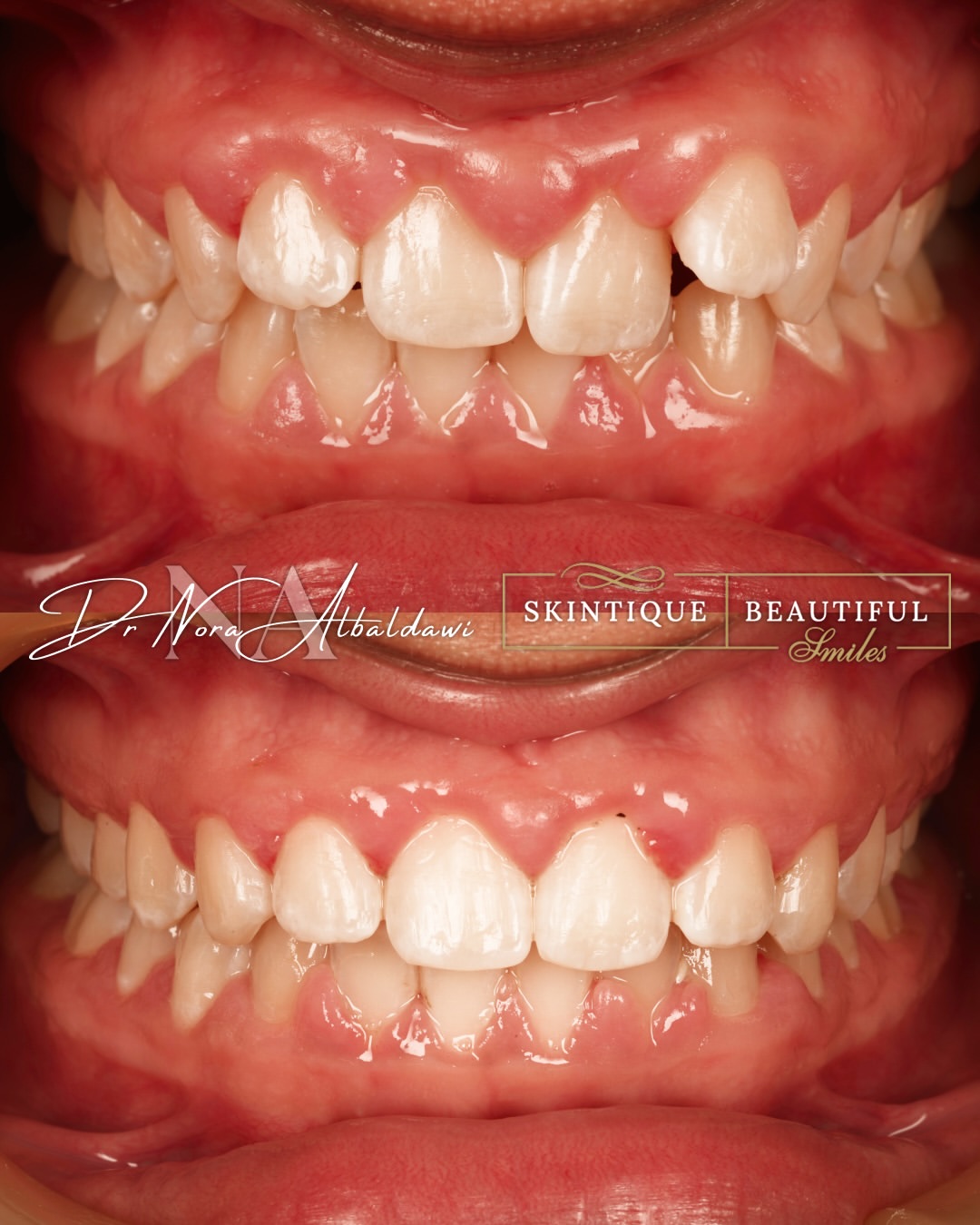 Damon braces smile image